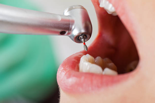 Best Emergency Dental Extractions in West Terre Haute, IN